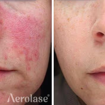 Aerolase