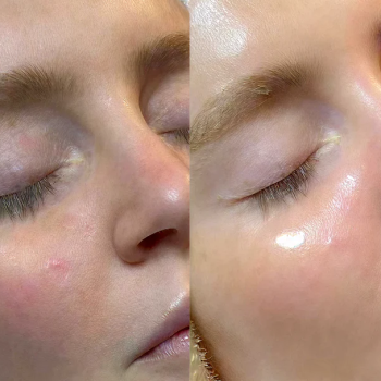 Hydrafacial