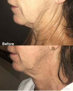 Morpheus 8 before and after 1 - 1