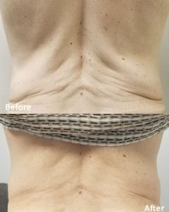 Morpheus8 before and after 2  - 1