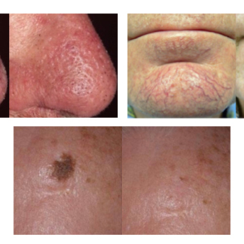 NewSurg Dermalight  KTP Laser