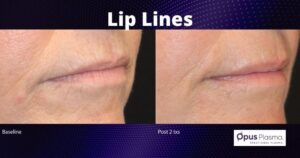 Lip Lines v3 Opus Plasma
