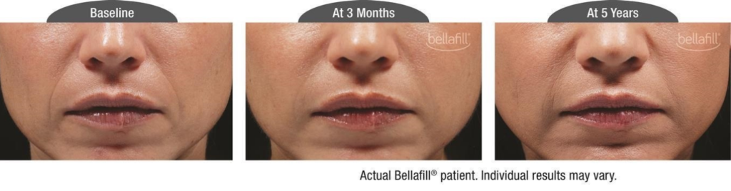 Bellafill Before and After