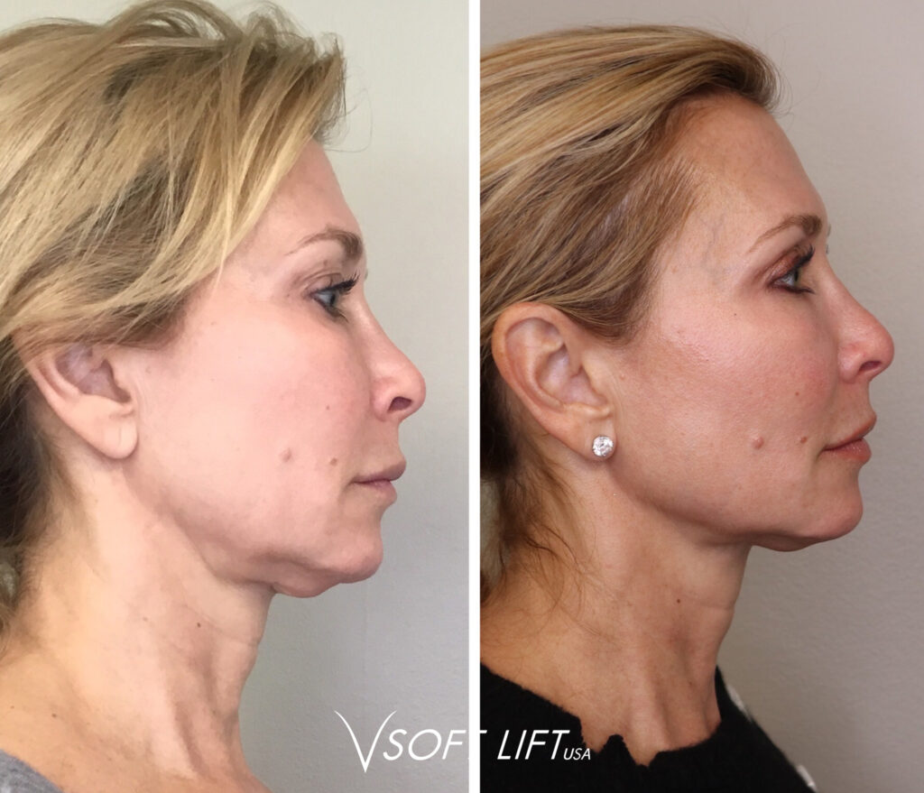 VSoft neck Before and After